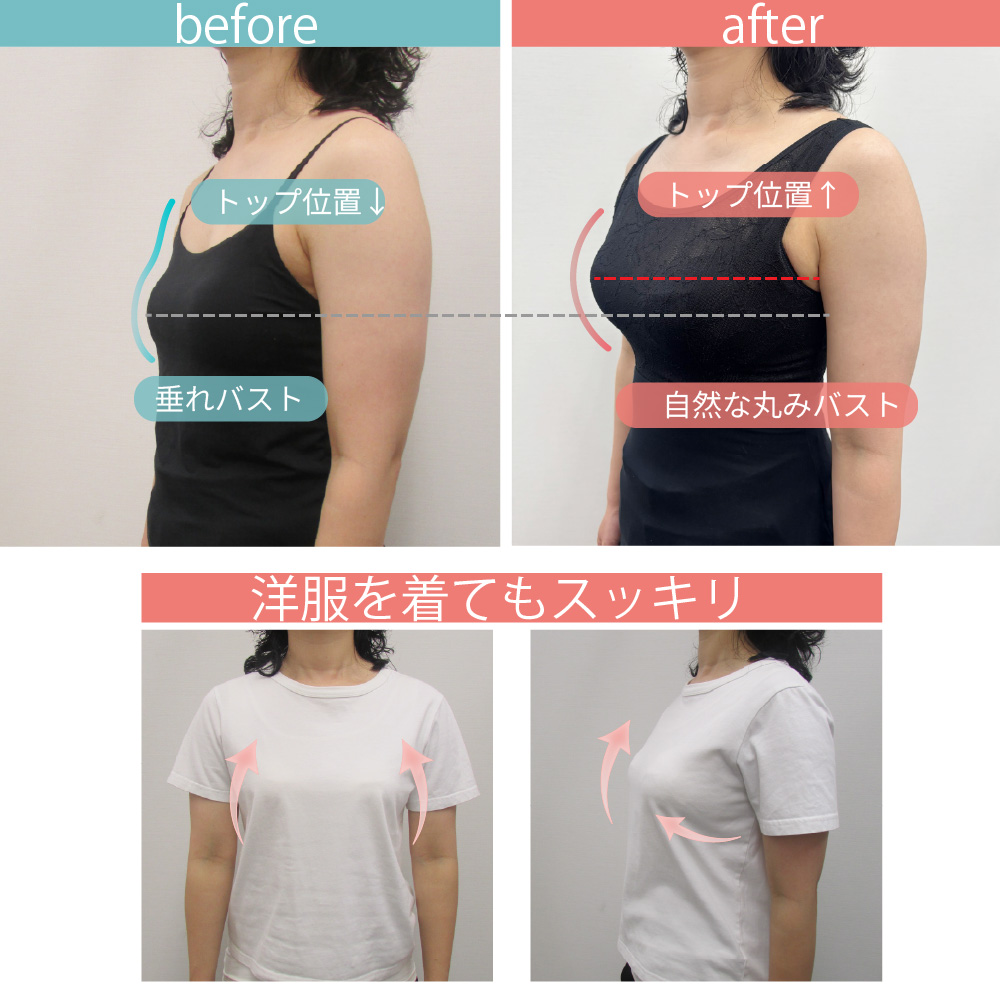PITALIFTの着用before/after｜垂れバストが自然な丸みバストに。洋服を着てもすっきり